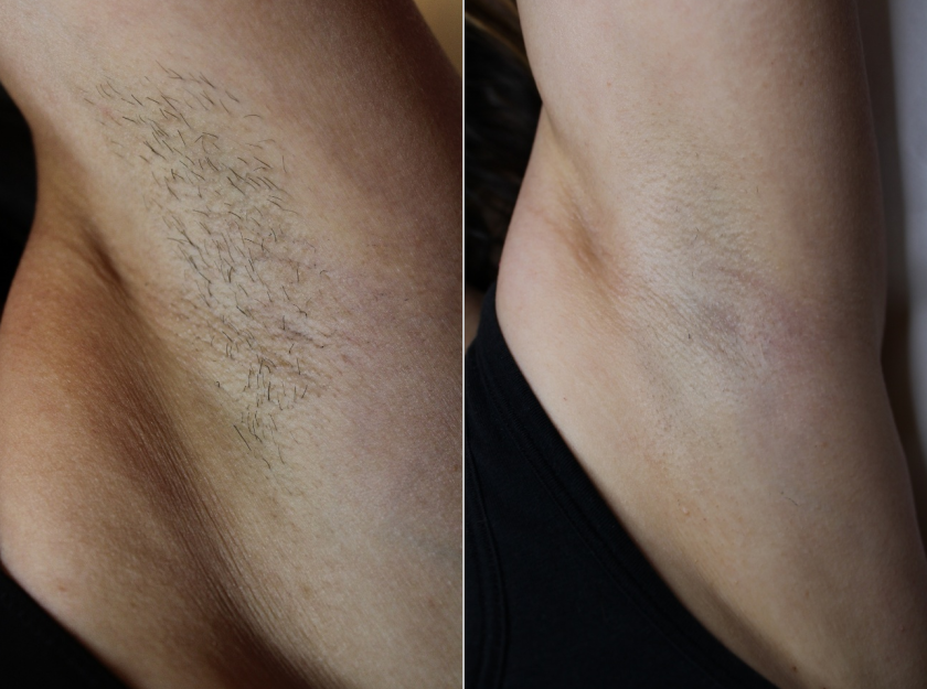 epilazione laser