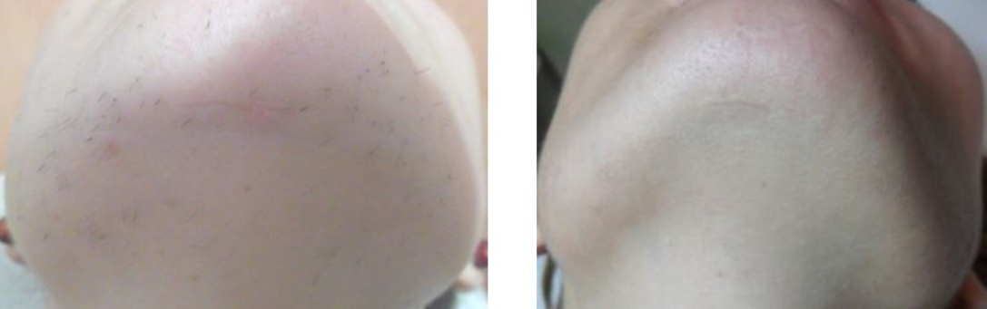 epilazione laser