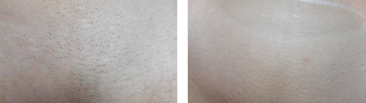 epilazione laser