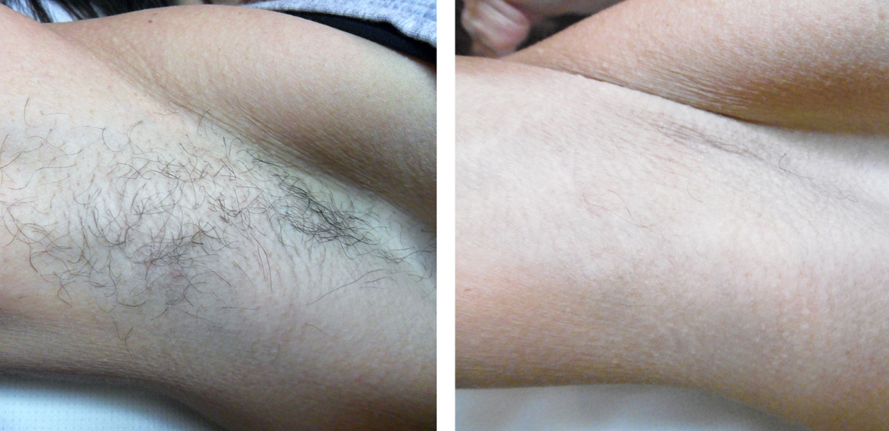 epilazione laser