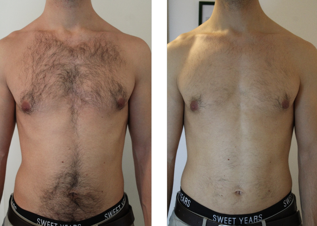 epilazione laser