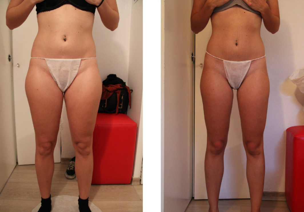 rimedio cellulite