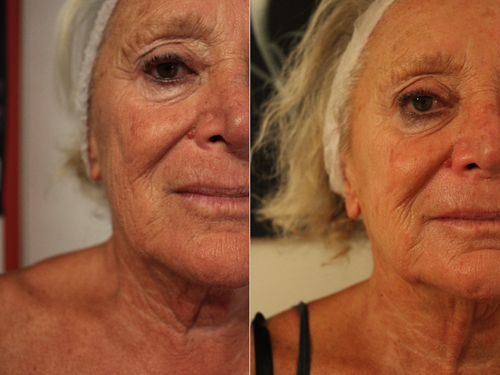 Skin Longevity viso, prima e dopo