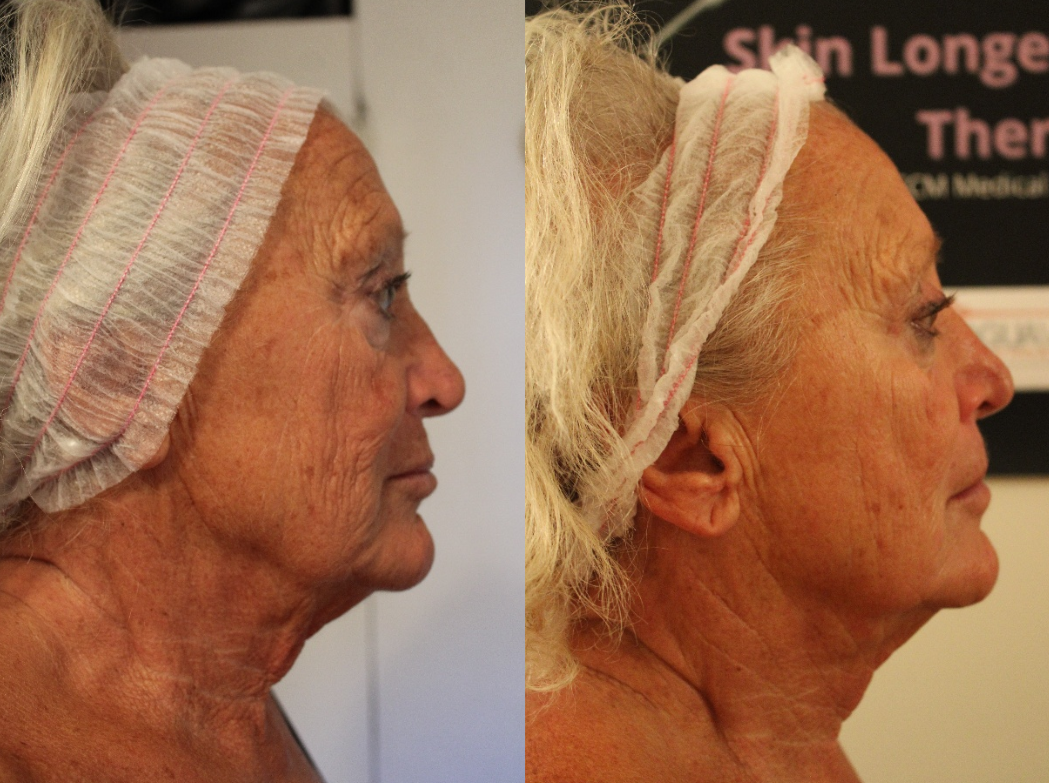 Skin Longevity viso, prima e dopo
