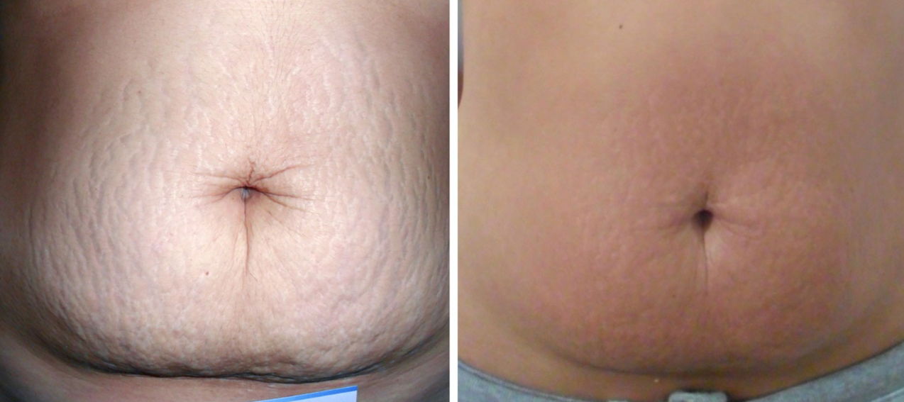 cura prima e dopo smagliature