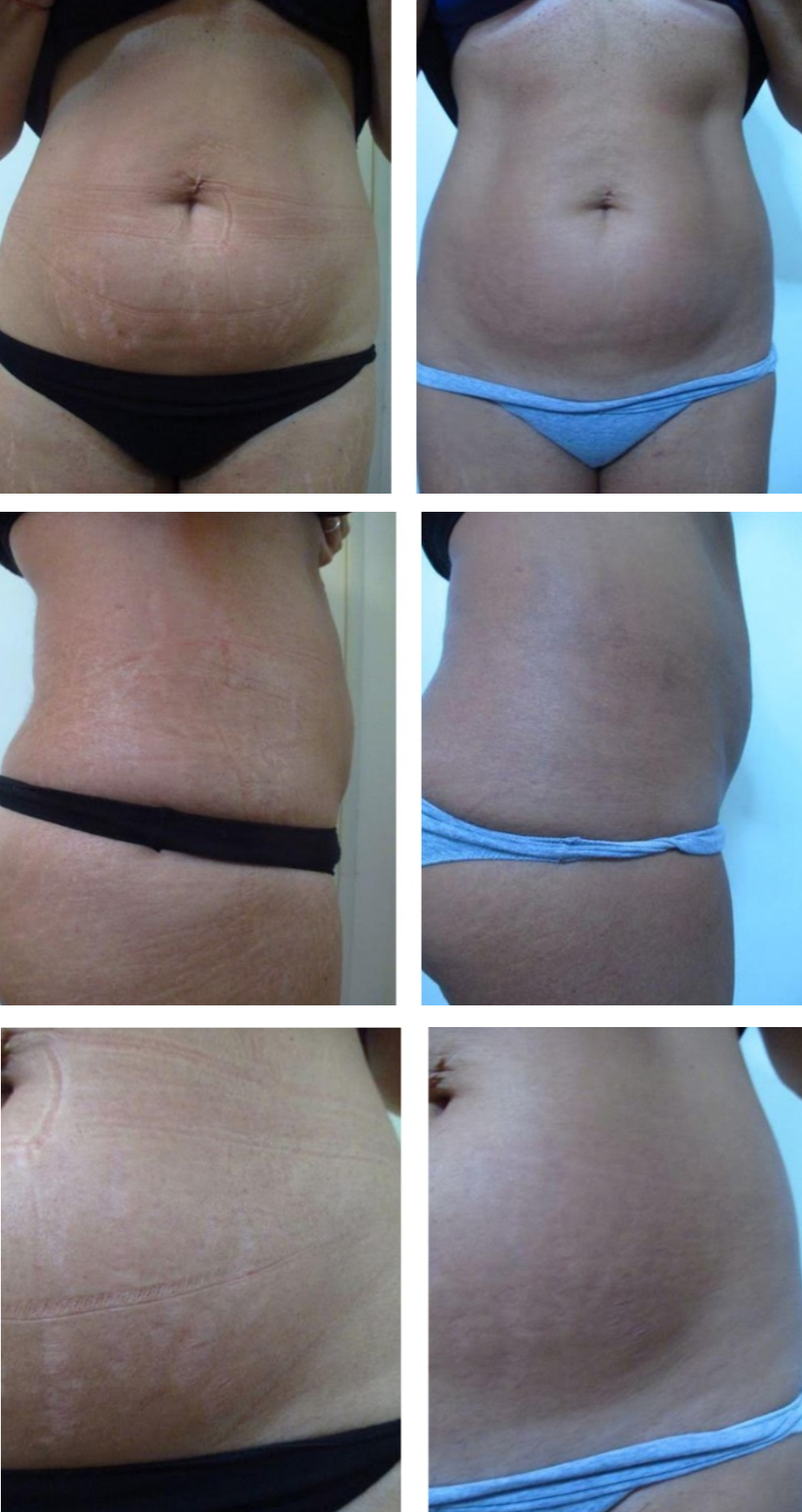 cura smagliature prima e dopo