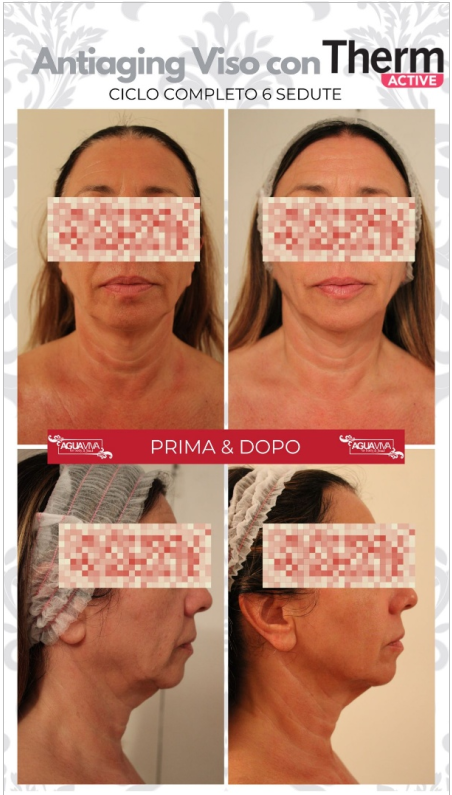 thermactive viso