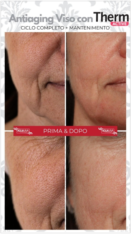 thermactive viso