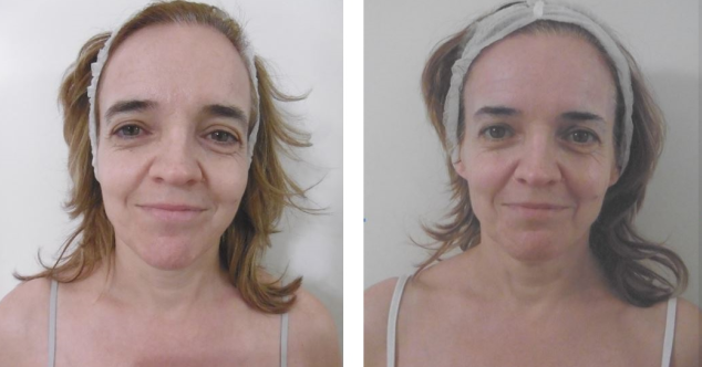 trattamento viso prima e dopo