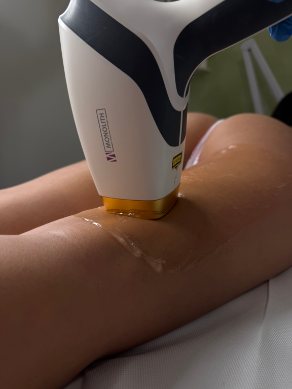 epilazione laser